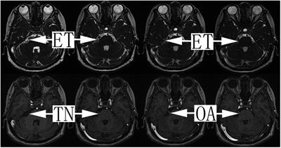 Strategies for intraoperative management of the trigeminal nerve and long-term follow-up outcomes in patients with trigeminal neuralgia secondary to an intracranial epidermoid cyst